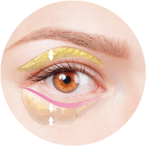 Eye Bag Removal Surgery